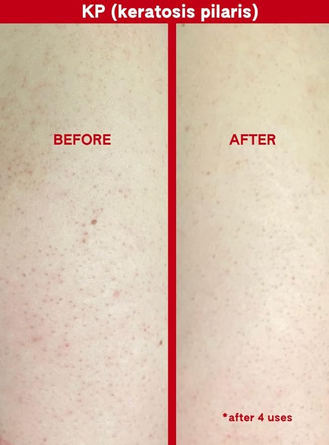 ABI AMÉ Soft-Touch Chemical Body Exfoliant - Smoothing and Softening Pre-Shower Body Mask - 30% AHAs + 2% BHAs, Safe for Sensitive Skin - 150ml/5.1 Fl oz