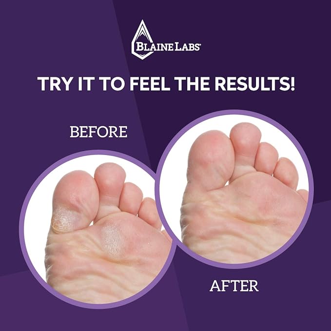 Blaine Labs: Vite20 Advanced Callus Treatment - Extreme Callus Remover for Feet - 4 oz. - Advanced Skin Care for Dry, Cracked Feet - Great for Foot Spa and Pedicure Kits - 40-percent Urea - Works Fast