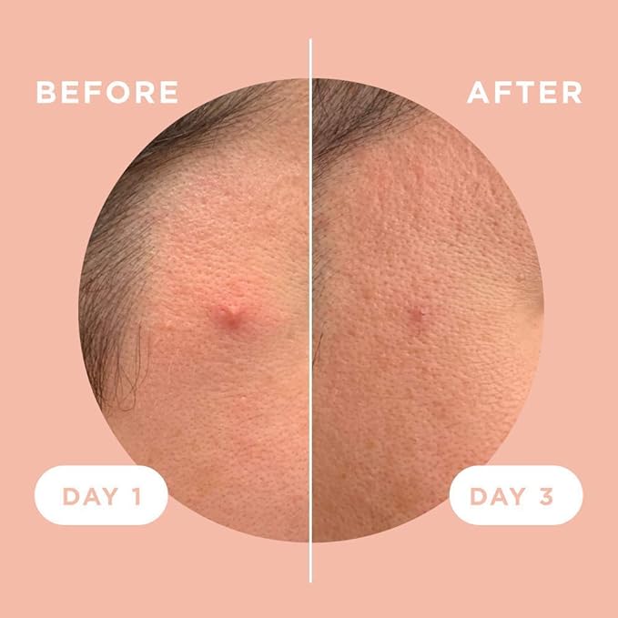 ZitSticka Killa Pimple Patches for Face - World's Most Potent Pimple Patch with Fast-Acting Microdarts - Starts Working within 6 Hours for Deep, Early-Stage Zits - Regular 8 Count with Cleana Swab