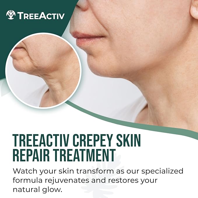 TreeActiv Crepey Skin Repair Treatment Original Formula, 8 fl oz, Firming Cream For Face & Neck, Skin Firming Lotion with Hyaluronic Acid, Crepey Treatment to Address Dry Crepe