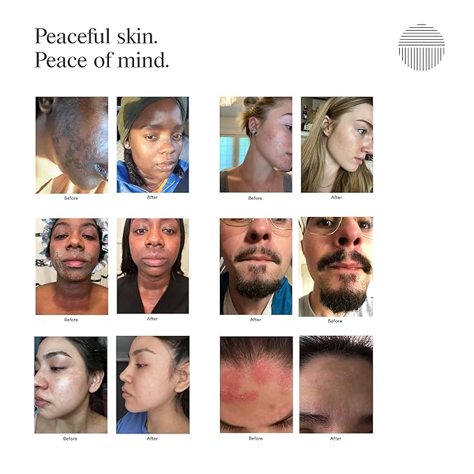 Calming Seborrheic Serum, Dermatologist Recommended, Topical Seborrheic Dermatitis Serum For Scalp, Face, and Body (8oz)