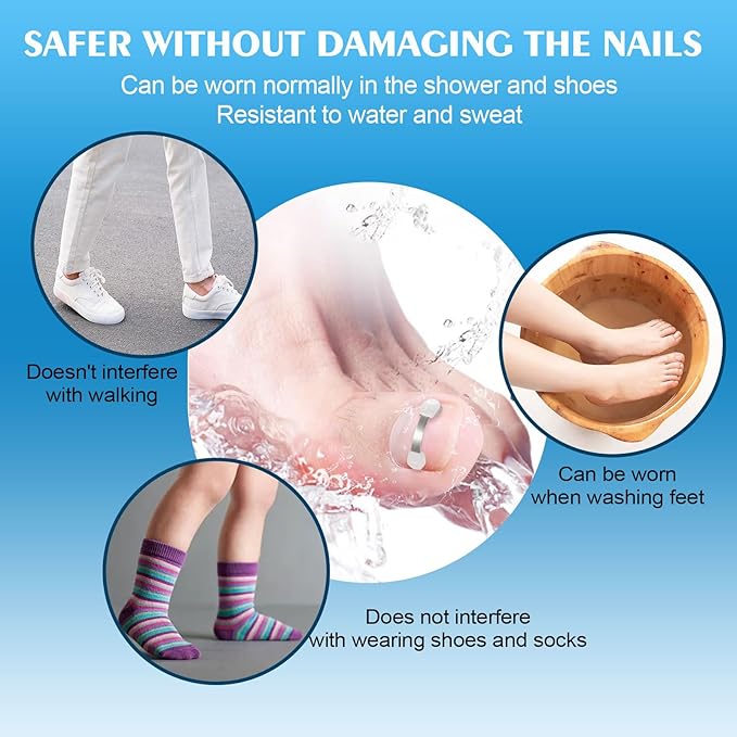 Titanium Alloy Silicone Ingrown Toenail Treatmen,Ingrown Toenail Removal Ingrown Toenail Removal Kit ngrown Toenail Removal Kit,Designed for Curved Nail Repair,Ingrown Toenail (0.67-0.79in)