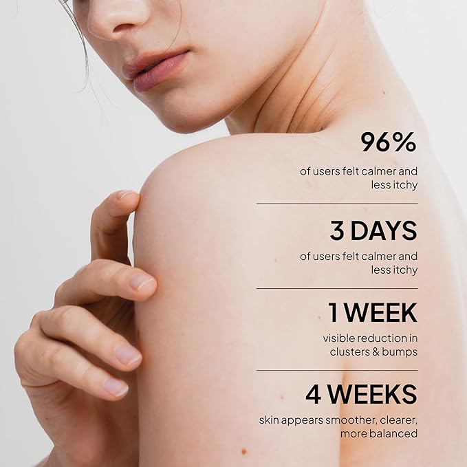 Fungal Acne Treatment Lotion: Effective Face & Body Pimple Cream for Bumps, Clusters, Itch & Redness – Fungal Prone Skin Acne Treatment Moisturizer for Teens & Adults with Natural Actives