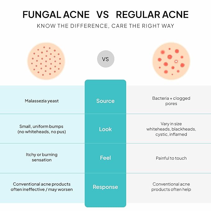 Fungal Acne Treatment Lotion: Effective Face & Body Pimple Cream for Bumps, Clusters, Itch & Redness – Fungal Prone Skin Acne Treatment Moisturizer for Teens & Adults with Natural Actives