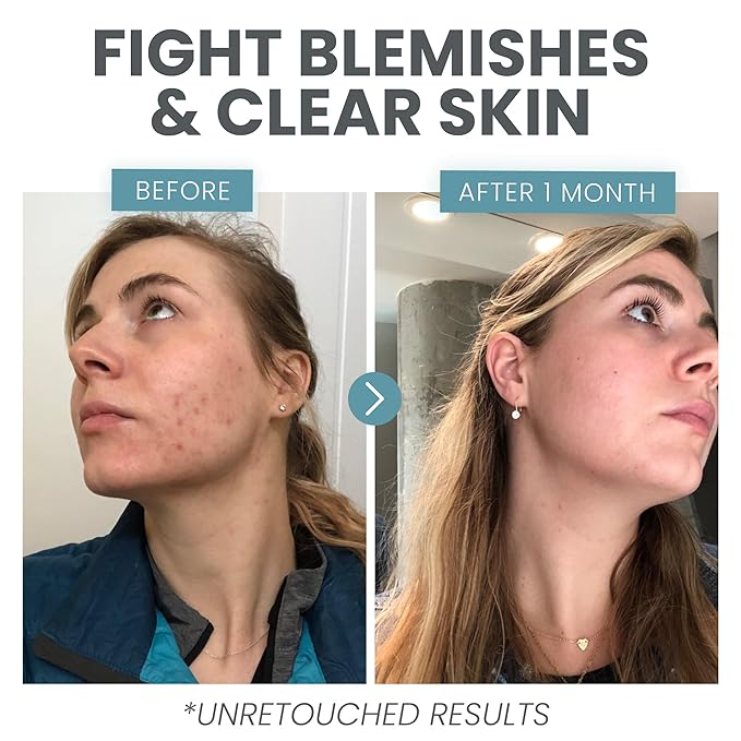 Vitamin C Serum for Face - Skin Clearing Serum with Salicylic Acid Retinol, Niacinamide and Hyaluronic Acid - Skin Brightening Acne Serum - Anti Aging Dark Spot Treatment(1 oz)