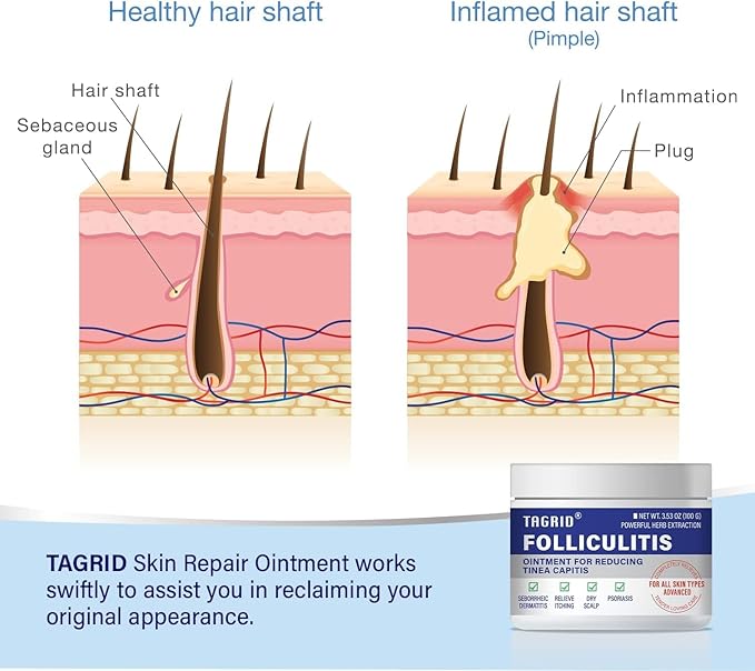 TAGRID Folliculitis Treatment Cream, Ingrown Hair Treatment, Soothing Scalp, Face & Body Cream - Hydrating & Refreshing - 100g
