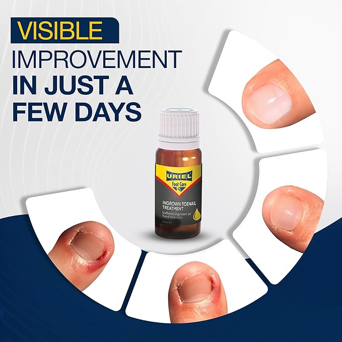 URIEL UPGRADED Ingrown Toenail Treatment with Silicone Caps, Ingrown Toenail Removal Kit, Ingrown Nail Kit Relief with Ingrown toenail drops 11 ml
