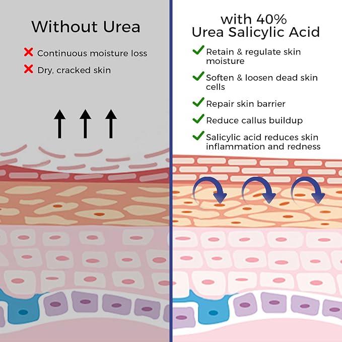 Urea Cream 42% plus Salicylic Acid 2% Intensive Repair Treatment for Cracked Skin on Hands, Heels, Elbows, and Lips - Relief for Dry Feet - Enhanced Pump Dispenser Packaging - Gross wt 8.03 OZ