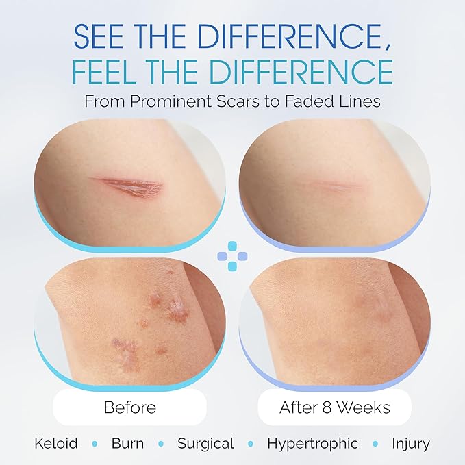 Advanced Scar Treatment - Medical Grade Silicone Scar Sheets, Long Water-Resistant Silicone Scar Tapes for Surgical Scars, Stretch Marks, Keloid Bump - 7 inch, 12 Strips