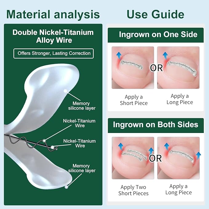Dual Nitinol Ingrown Toenail Corrector,Ingrown Toenail Treatment,Curved Toenail Straightener,Ingrown Toe Nail Relief,Ingrown Toenail Removal Kit,Big Toe Ingrown Toenail Tool (0.55in,0.66in)