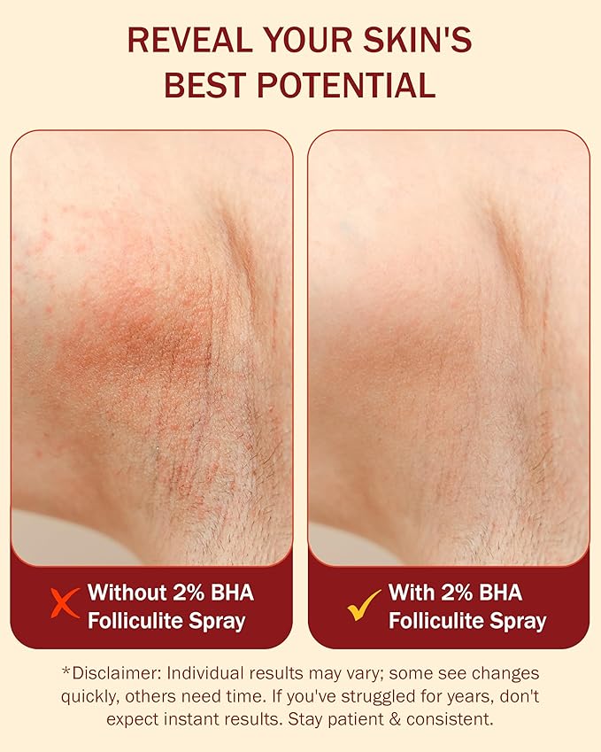 2% BHA Folliculite Body Oil Spray - Salicylic Acid Body Mist with Tea Tree Oil & Aloe Vera - Spray Moisturizer for Dry Skin, Clogged Pores & Irritation, 4 fl. oz