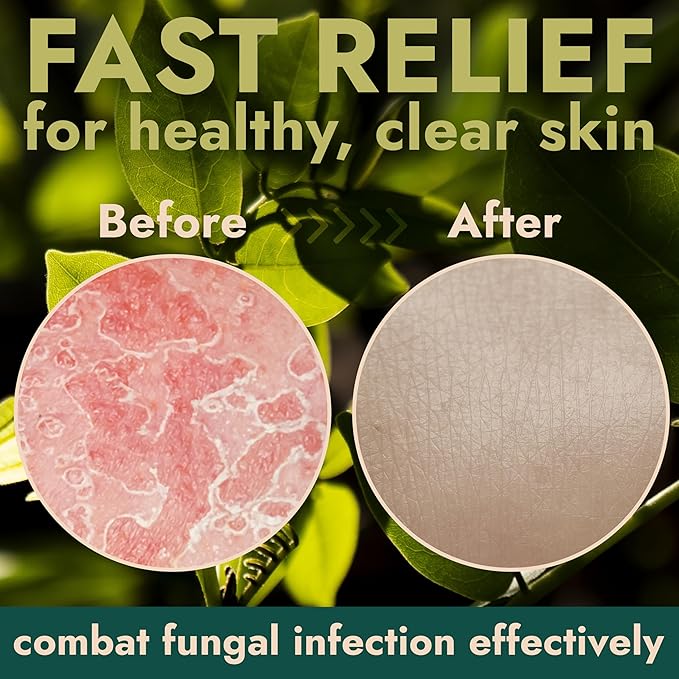 Antifungal Soap | Medicated Jock Itch Treatment, Fights Ringworm & Athlete's Foot | Soothing Tea Tree & Antibacterial | 1% Tolnaftate for Effective Relief | Travel-Friendly with Soap Case Pack of 2