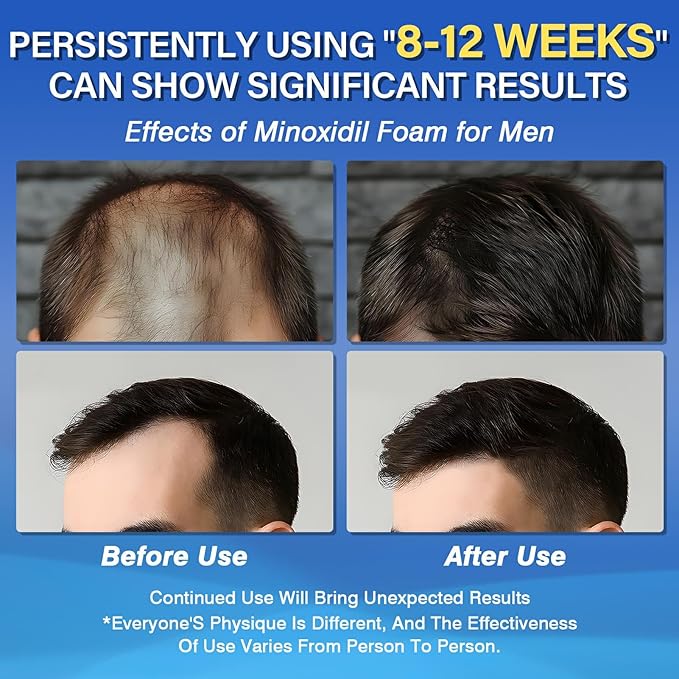5% Minoxidil Foam for Men Hair Growth Foam Suitable for Hair Thinning Receding Hairline and Hair Loss to Hair Regrowth Get Thicker Fuller Hair 3 Bottles 2.11 Ounces Each