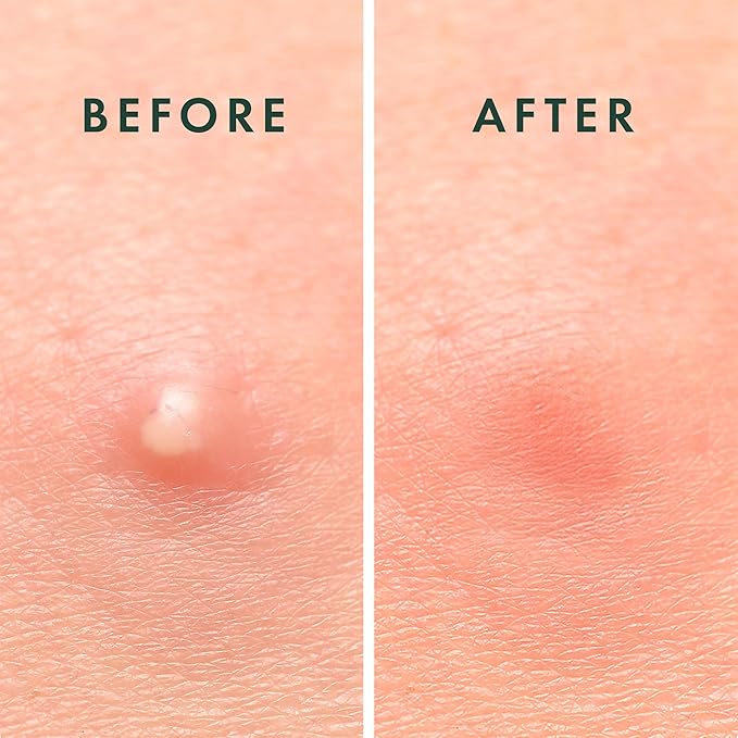 Rael Pimple Patches, Miracle Invisible Spot Cover - Hydrocolloid Acne Patch, Treatment for Breakouts, Absorbs Zits & Blemish, Korean Skin Care, 2 Sizes (96 Count)