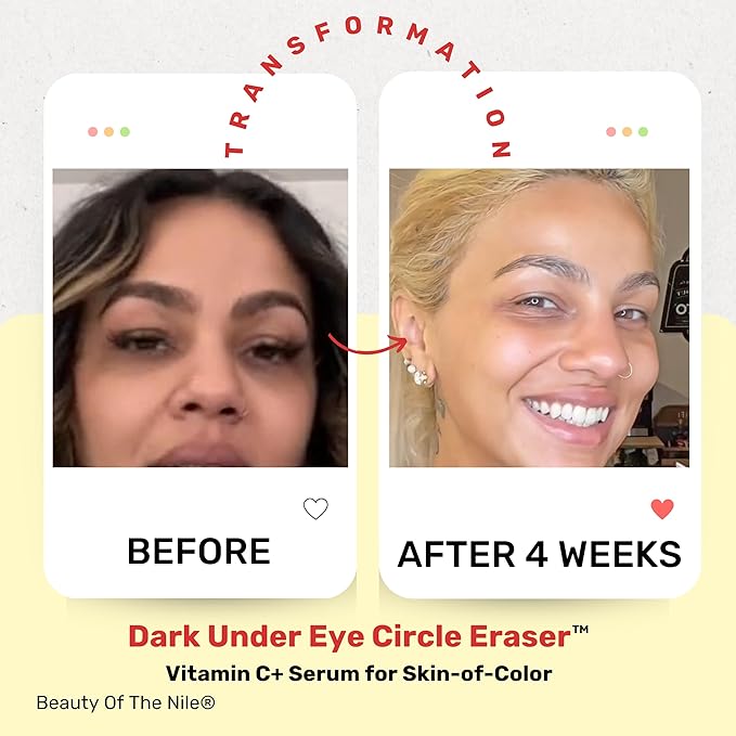 Dark Under Eye Circle Eraser™ Vitamin C+ Serum for Skin-of-Color, Dark Circle Puffiness Wrinkle Hyaluronic Acid Superoxide D, Beauty of the Nile® 1 Oz