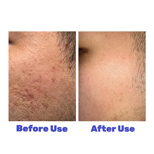 4 PC- ONIYEA Sea Salt Handmade Bar Soap 3.5 Oz Each, Natural Goat's Milk, All Skin Types, Exfoliating Acne Deeply Clean Problem Skin, Body/Face/Hand Wash Skincare, Women Men Birthday Mother Valentine