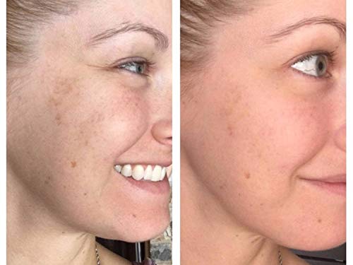 Su-Skin Retinol Serum 4% Vitamin A for Anti Aging, Dark Spots, Wrinkles