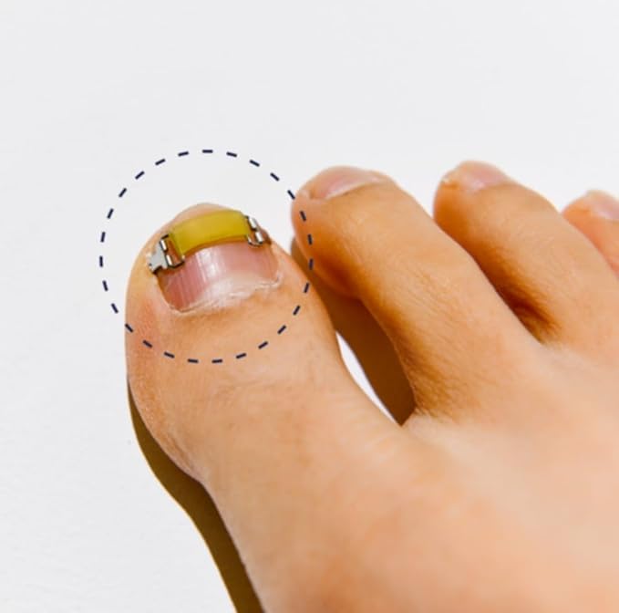[S/0.67inches/16-18mm] Ingrown toenail treatment by latex ring elasticity, usable in everyday life, Ingrown toenail corrector, Yellow/Silver