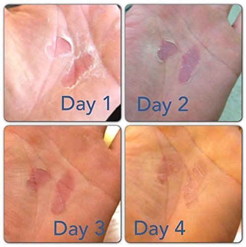 Hand Tear Repair - Rip Fix Stopper Balm for Gymnastics - Climbers Hand Balm - Wod Callus Hand Care - Climbing Hand Repair Balm Cream - Treatment for Cracked or Ripped Hands 1.34 oz - Pack of 3