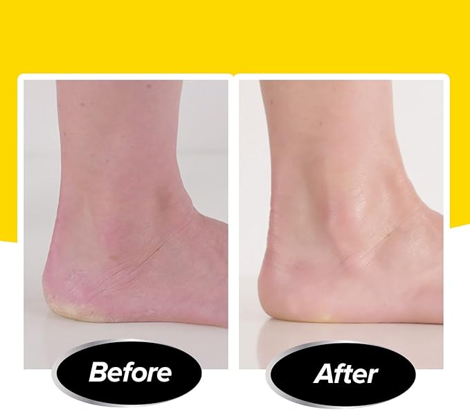 As Seen On TV Electric Callus Remover + Built-In Vacuum Sucks Up Shavings,Gently Removes Calluses & Dry Skin in Seconds, Mess-Free, Spins at 2000 RPMs, LED Light, 2 Speed Settings, 3.5"x 2.5"