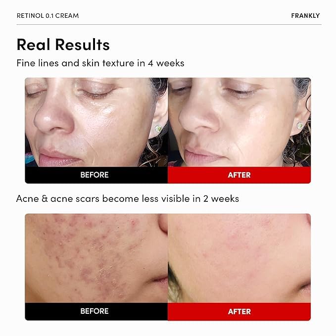 FRANKLY Retinol 0.1% Cream, 1.01 fl oz - Beginner Retinol | Night Cream | with Ceramides & Natural Ginseng | Anti-aging, Wrinkles Care, Reduces Congestion and hyperpigmentation | Korean Skin Care