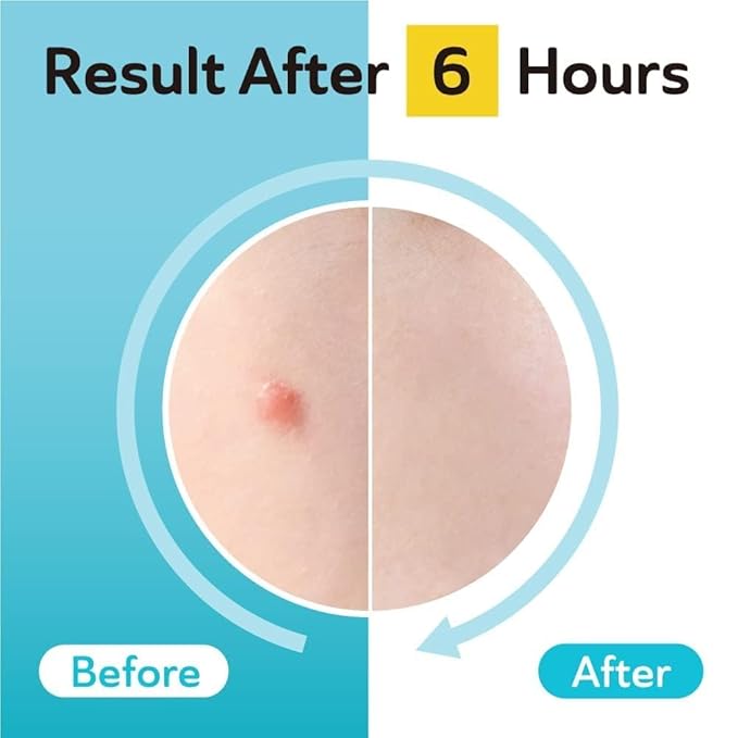 Acne & Post Acne Patches - Hydrocolloid Pimple Care with TXA & CICA for Active Acne & Post-Inflammatory Dark Spots - Day and Night Use - UPGRADED (Post Acne - 132 Count - 1 Size)