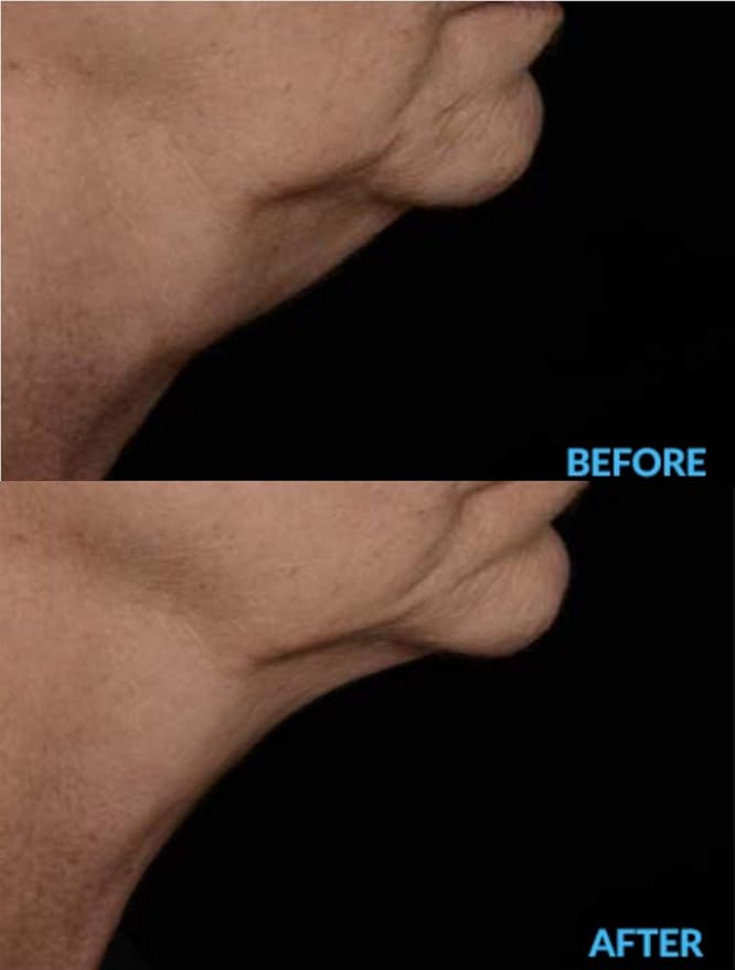 N.E.C.K Control: Neck Lifting, Firming And Retracting Cream