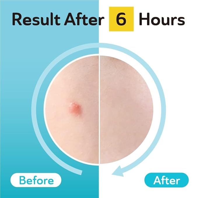 Acne & Post Acne Patches - Hydrocolloid Pimple Care with TXA & CICA for Active Acne & Post-Inflammatory Dark Spots - Day and Night Use - UPGRADED (Post Acne - 96 Count - 1 Size)