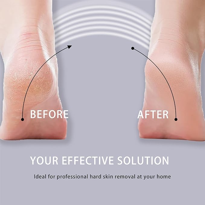 Foot Callus Remover, Rechargeable Electronic Foot File- Ideal Gift, Professional Pedicure Tools, Waterproof Foot Scrubber, Electric Pedicure Kit Feet Care for Dead Skin- Long Service Time