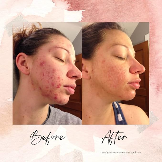 LEROSETT Spot Treatment Clay Mask & Moisture Matte™ Bundle