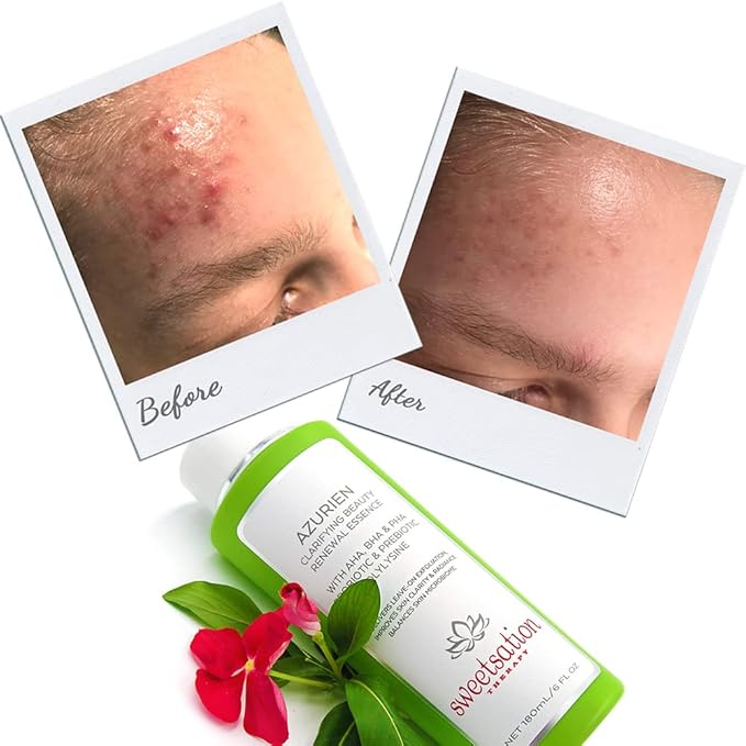 Sweetsation Therapy/YUNASENCE AZURIEN Clarifying Beauty Renewal Essence, 6oz. with Blend of 7 Types of AHA+BHA+PHA to Gently and Naturally exfoliate and Renew.