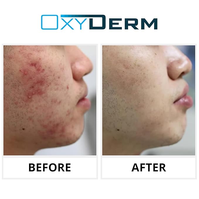 Acne Treatment Pads- Eliminates Pimple, Whitehead, blackhead, & Cystic Breakouts. Clear Clogged Pores, Oily Skin, Blemish, Dark Spots & Improve Skin Texture. 60 count