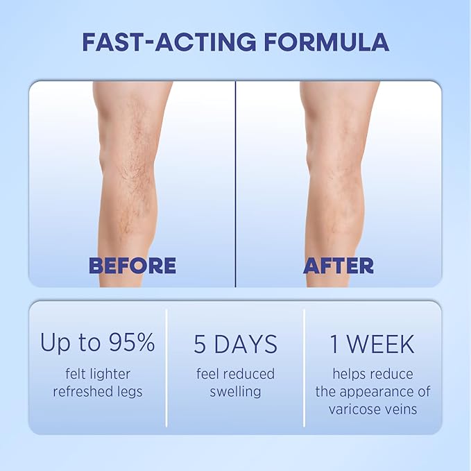 Hermon Varicose Veins Cream, Varicose Veins for Legs Made in Italy, Spider Vein for Legs, Natural Soothing Leg Varicose & Spider Veins Cream - 5.07 Fl Oz (Pack of 1)