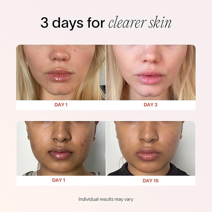 Solawave Bye Acne Spot Treatment | Premium Pimple Red Light Therapy & Blue Light Recovery | Use Before Pimple Patches | Acne Care Light Device | Face Care Must-Have | Solawave Original