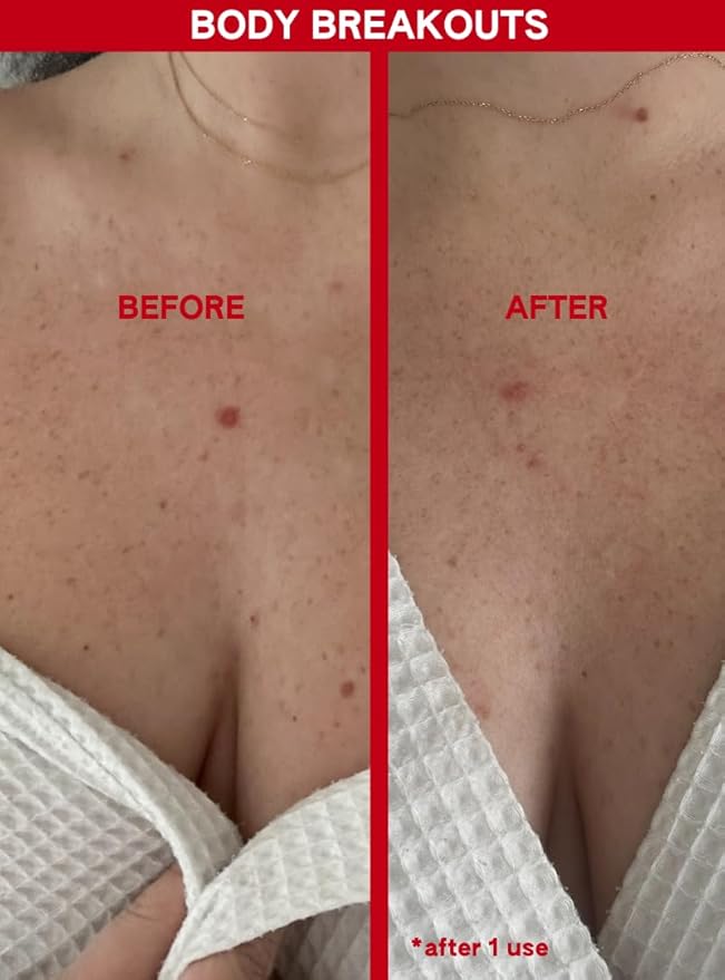 ABI AMÉ Soft-Touch Chemical Body Exfoliant - Smoothing and Softening Pre-Shower Body Mask - 30% AHAs + 2% BHAs, Safe for Sensitive Skin - 150ml/5.1 Fl oz