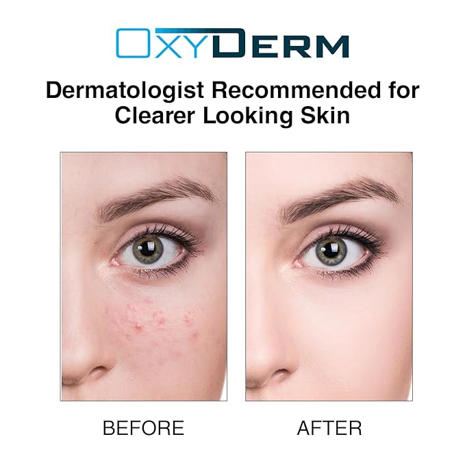 Acne Treatment Pads- Eliminates Pimple, Whitehead, blackhead, & Cystic Breakouts. Clear Clogged Pores, Oily Skin, Blemish, Dark Spots & Improve Skin Texture. 60 count