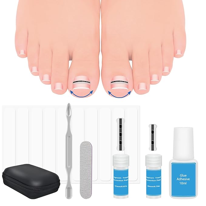 Upgraded ingrown toenail treatment, nail kit, Ingrown Toenail Treatment, Ingrown Toenail Removal Kit, Designed for Curved Nail Repair, Ingrown Toenail Corrector, Suitable for many types of correction.