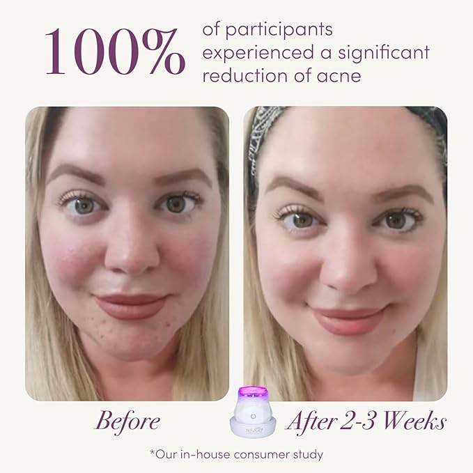 reVive Light Therapy - Mini Soniqué LED Light Therapy Anti-Acne Sonic Facial Cleansing Brush, Reduces Appearance of Acne & Wrinkles, Travel Friendly