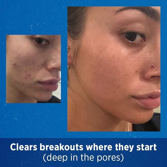 Differin Adapalene Gel 0.1% Acne Treatment, 0.5 Ounces each (Value Pack of 3)