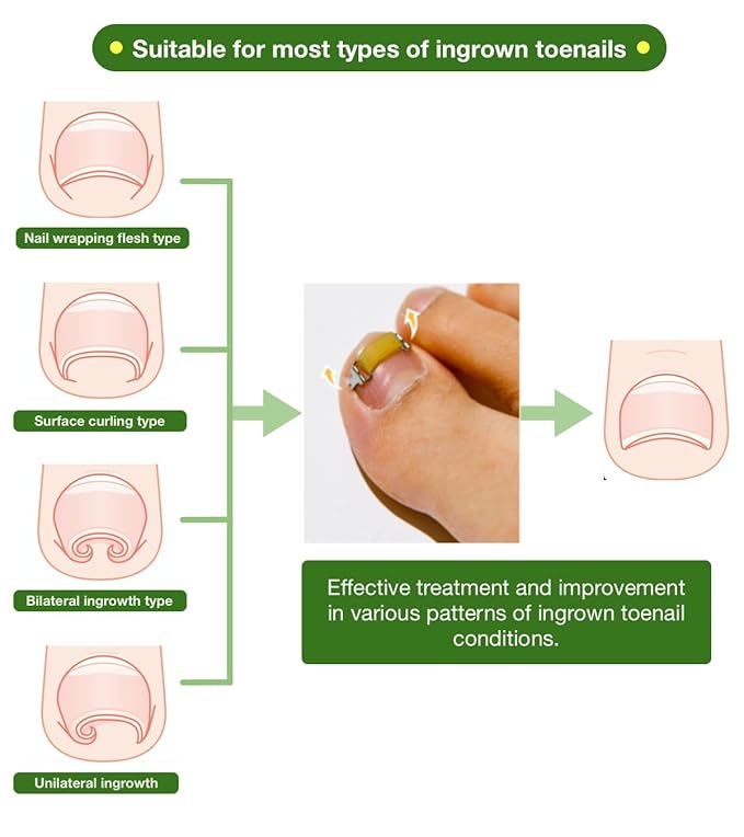 Ingrown Toenail Treatment & Corrector with Latex Elasticity - Curved Toenail Straightener | Effective Daily Solution for Ingrown Toenail Pain & Growth Correction [XL/0.87inches/21-23mm]