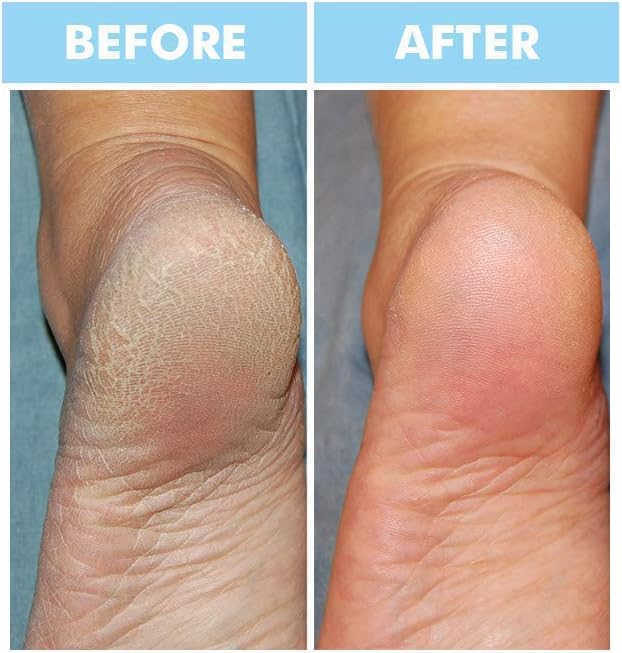 Bodipure Premium Hand and Foot Mask | Moisturizing Kertain Gloves & Socks | Hydrating Dull Dry Hands, Cracked Heels, Callus Softening & Nail Strengthening | Chemical-Free Feet Treatment | (6+6 Pack)