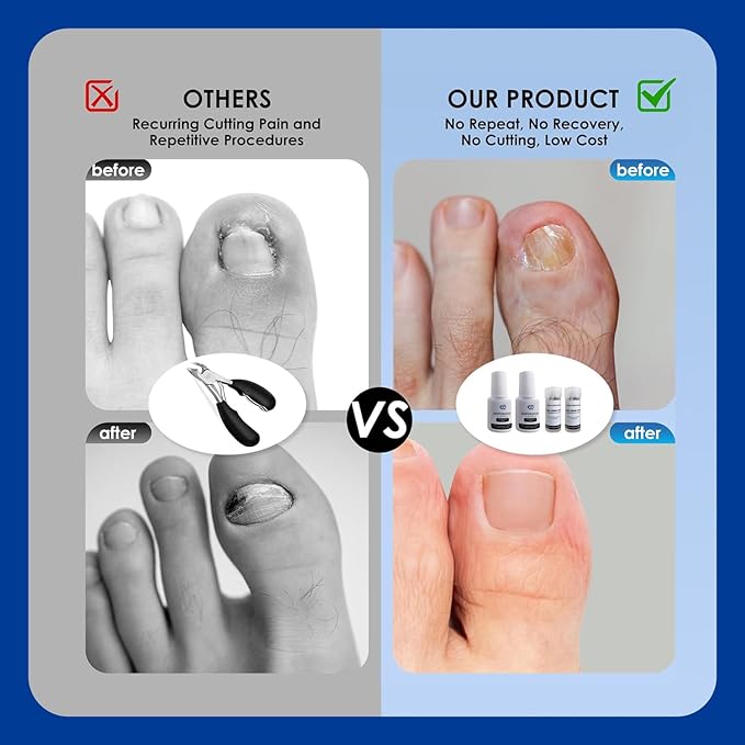 Titanium Alloy Ingrown Toenail Treatment, Nail Tools, and Ingrown Toenail Removal Kit Specially Designed for Curved Nail Repair and Ingrown Toenail Corrector