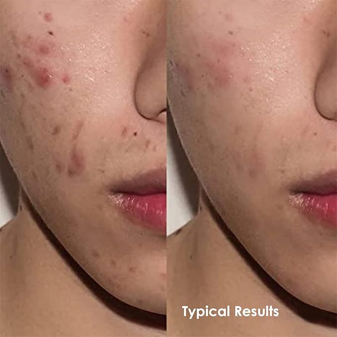 Tinted Moisturizer for Men by Apricus Skincare | Face Moisturizer Anti Aging and Anti-Redness | Dark Spot Concealer Cream and Redness Corrector | Matte Acne Face Moisturizer, 0.67 Oz, (Medium)