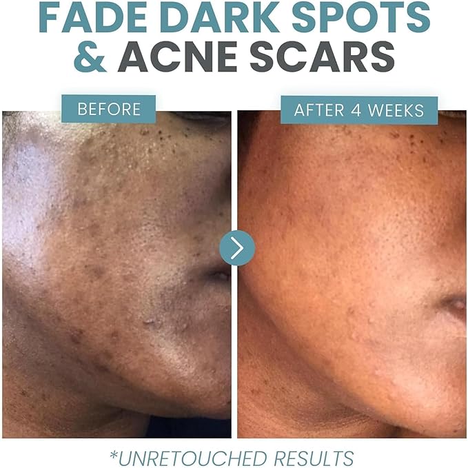 Vitamin C Serum Plus With Hyaluronic Acid, Retinol, Niacinamide, Salicylic Acid - Anti Aging Serum, Skin Clearing, Skin Brightening for Dark Spots (2 oz)