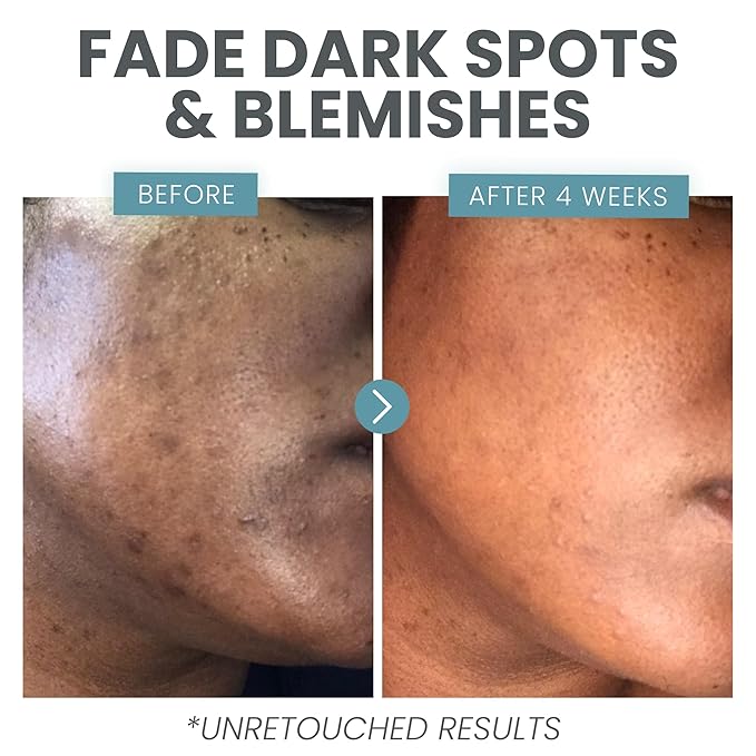 Vitamin C Serum for Face - Skin Clearing Serum with Salicylic Acid Retinol, Niacinamide and Hyaluronic Acid - Skin Brightening Acne Serum - Anti Aging Dark Spot Treatment(1 oz)