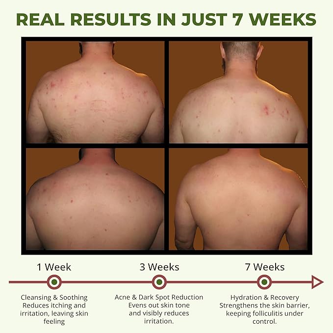 ABERA Folliculitis, BHA Shower Gel, High-Performance Folliculitis Body Wash, Wild Bitter Melon Extract, Reduces Back Acne & Hyperkeratosis,10,14 fl oz (2 Boxes + 1 BHA Back Acne Spray)