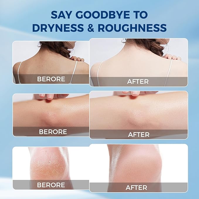 Urea Cream,NEW FORMULA Urea Cream 40 percent for Feet Maximum Strength,Dry Cracked Treatment Lotion for Knees & Elbows,Foot Dead Skin Cuticle Callus Remover Toenail Softener,5.29 oz 2 Packs