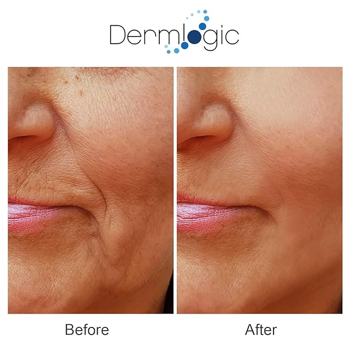 Anti Aging Resurfacing Peel Pads- Triple Action Chemical Peel Pads Combined with Glycolic, Lactic, and Salicylic Acids. Smooth’s Fine Lines, Wrinkles, Dark Spots, and Imperfections to Enhance the Skin