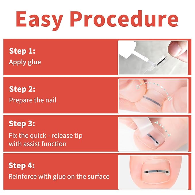 Ingrown Toenail Treatment, 10 packs Titanium Alloy Ingrown Toenail Corrector for all size foot, Ingrown Toenail Removal Kit for Curved Nail Repair, at Home Nail Kit Tools-Q03