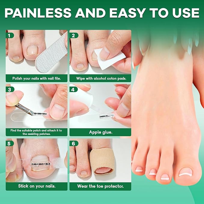 Titanium Alloy Ingrown Toenail Treatment New Version Ingrown Toenail Removal Tool Kit, Designed for Curved Nail Repair Big Toe Ingrown Toenail Corrector